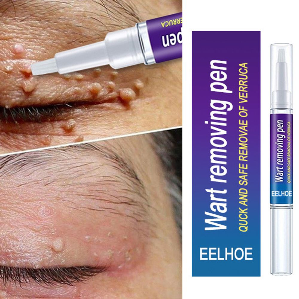 Removal Of Warts Liquid- Black Dots Beauty Health Skin Care