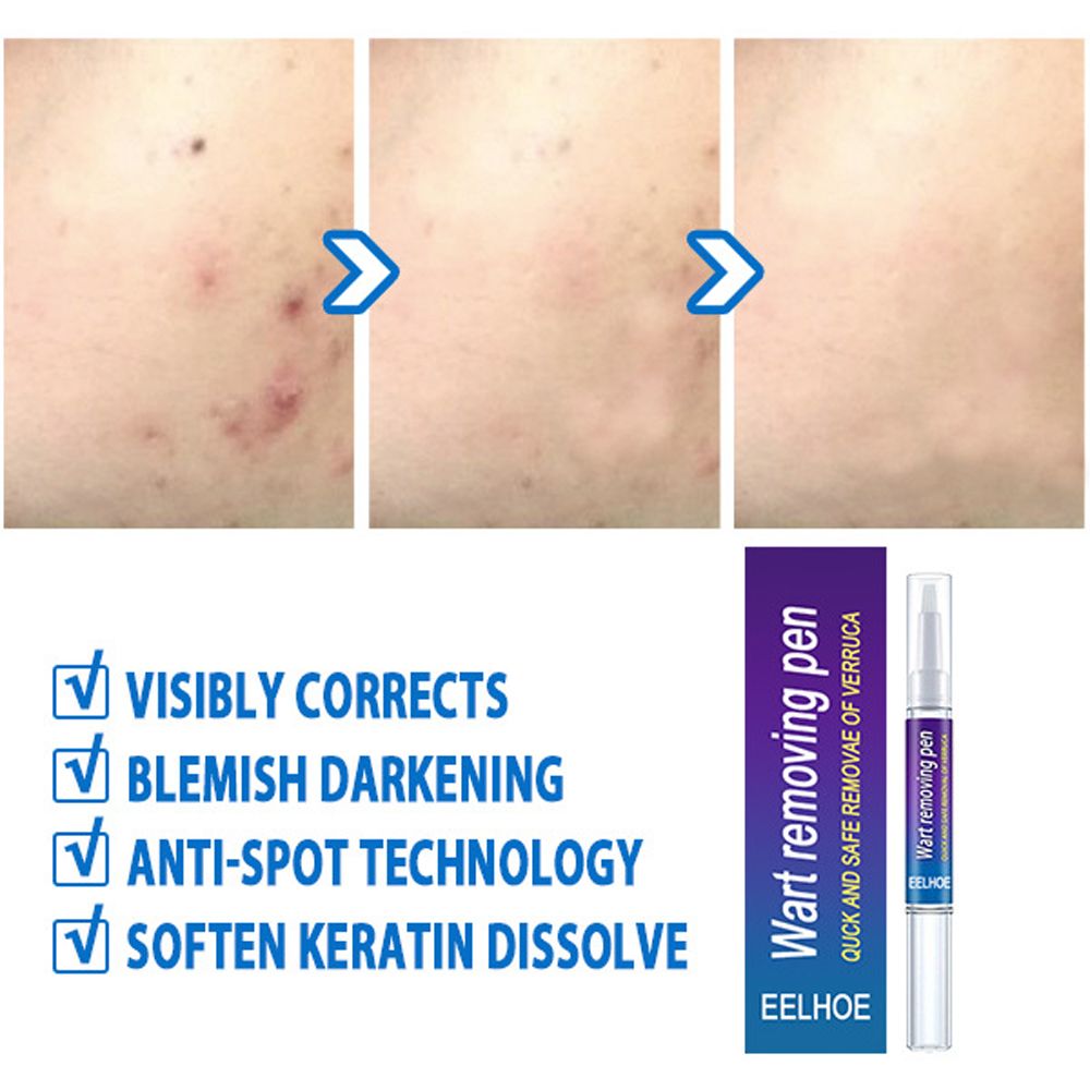 Removal Of Warts Liquid- Black Dots Beauty Health Skin Care